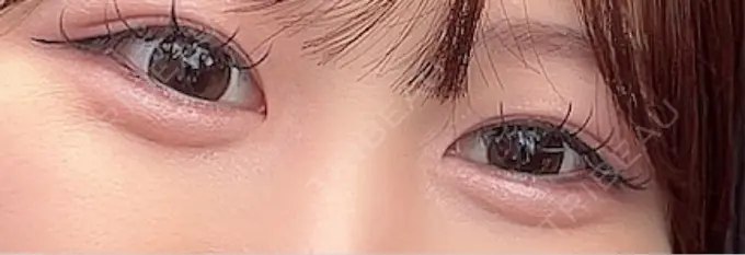 ヒアルロン酸注入（涙袋） / ボトックス（タレ目） アネシス美容クリニック AFTER メイン用