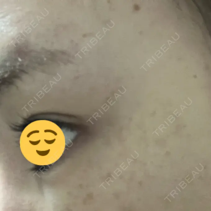 ボトックス（目尻） 東京美容医療クリニック 池袋院 DAY 6 メイン用