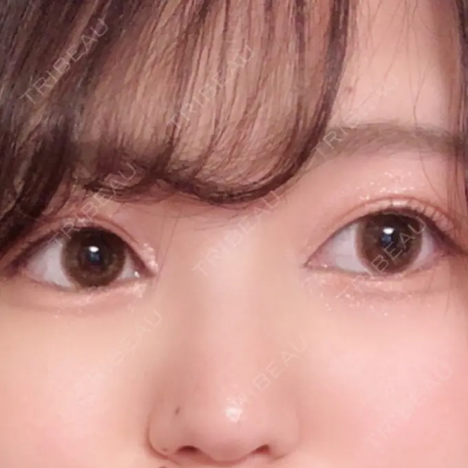 二重埋没 / 二重切開 / 矯正（ワイヤー） 湘南美容クリニック 橋本院 AFTER メイン用