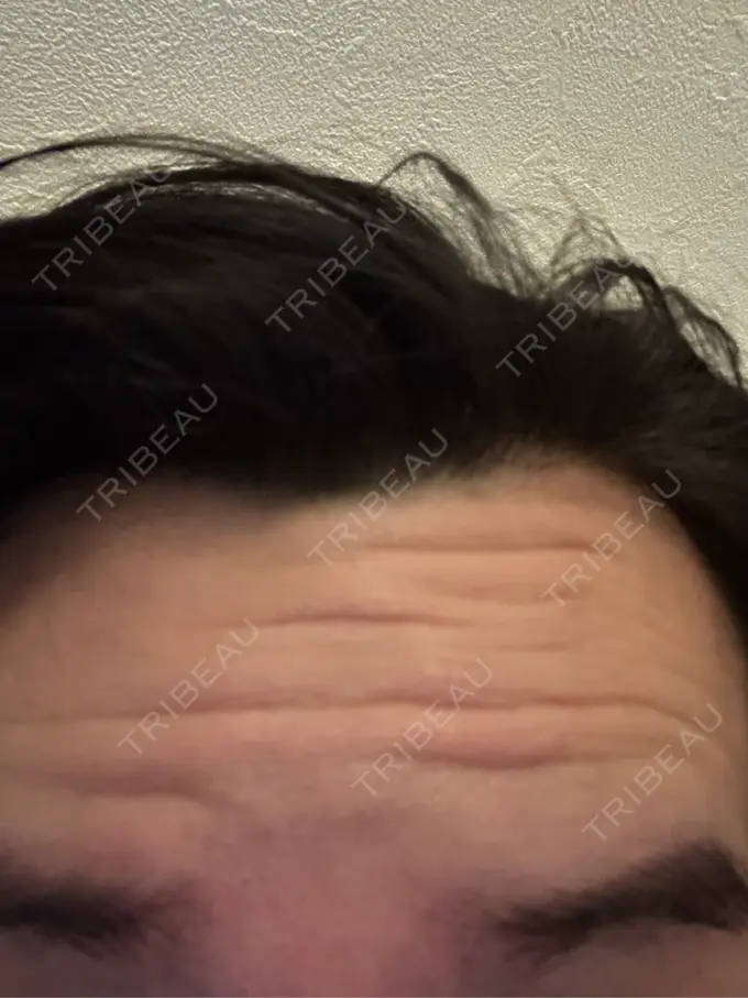 ボトックス（額） DMTC CLINIC 日本橋院 AFTER メイン用