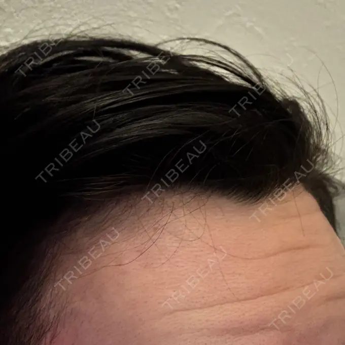 ボトックス（額） DMTC CLINIC 日本橋院 DAY 3 メイン用