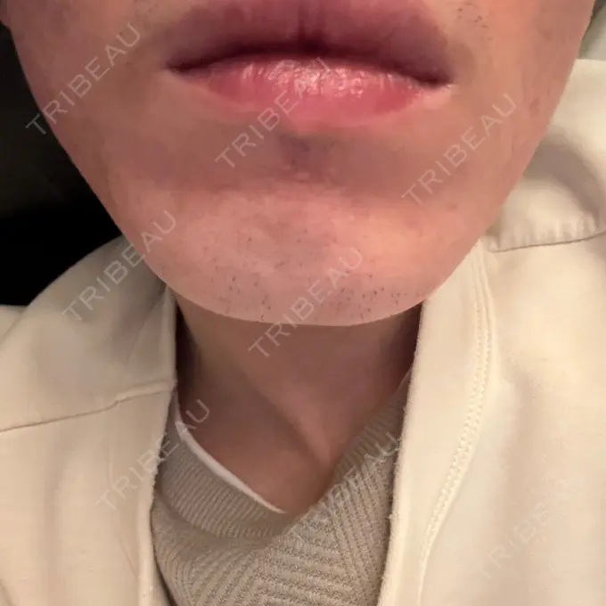 ボトックス（エラ・小顔） DMTC CLINIC 日本橋院 DAY 15 メイン用