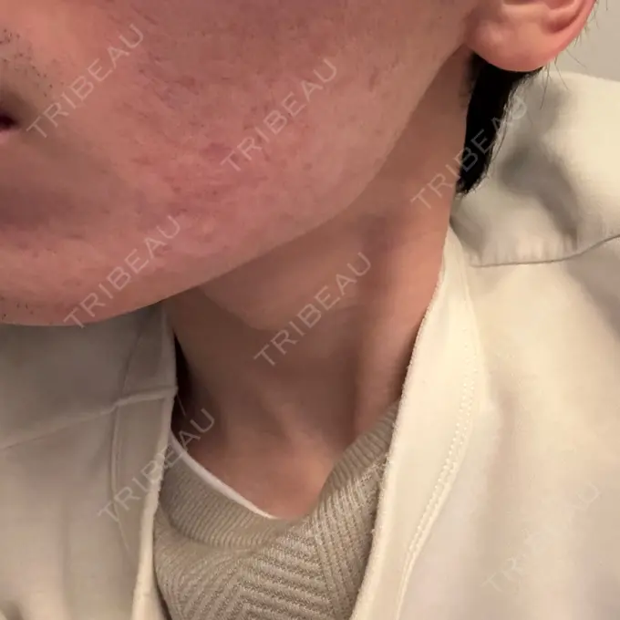 ボトックス（エラ・小顔） DMTC CLINIC 日本橋院 DAY 15 メイン用