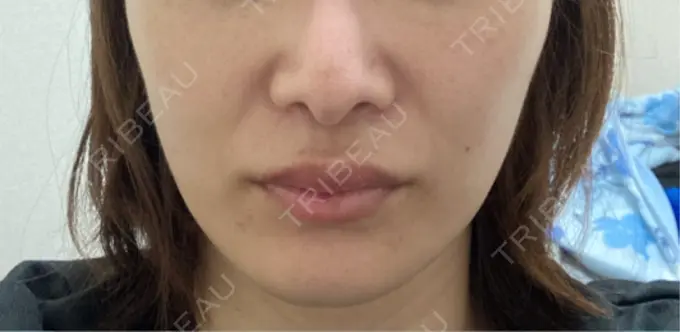 ヒアルロン酸注入（涙袋） / ヒアルロン酸注入（唇） 博多美容外科/美容皮膚科 ビラビューティークリニック AFTER メイン用