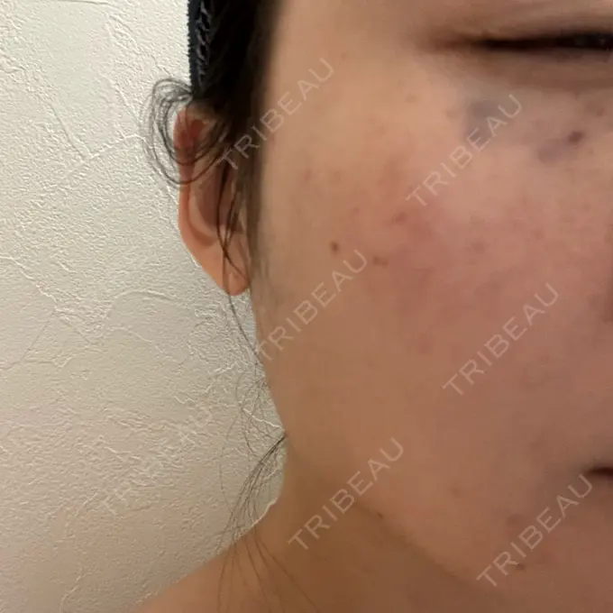 スネコス ルラ美容クリニック 仙台院 / ルラスキンクリニック 仙台院 DAY 14 メイン用