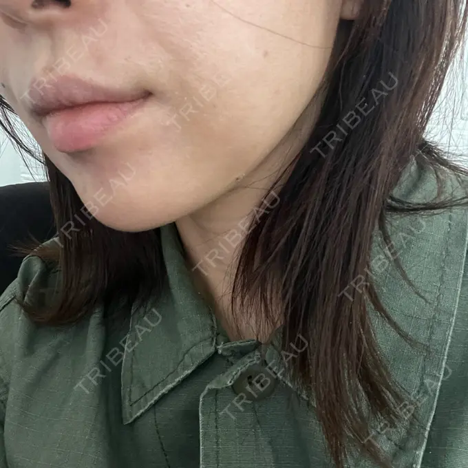 糸リフト / 脂肪吸引（顔） / 脂肪吸引注射（顔） ziz CLINIC DAY 1 メイン用