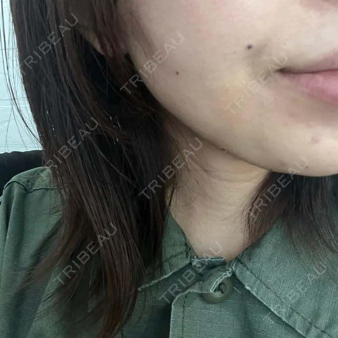 糸リフト / 脂肪吸引（顔） / 脂肪吸引注射（顔） ziz CLINIC DAY 1 メイン用