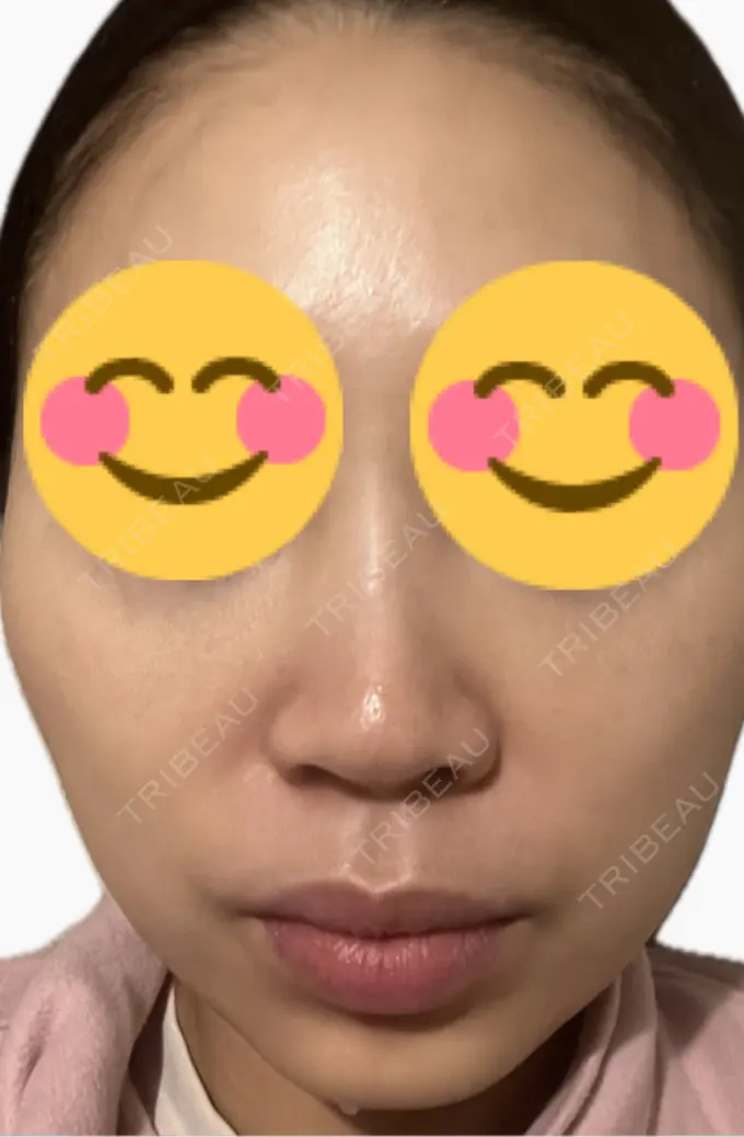 プラセンタ注射 美容皮膚科エルムクリニック 麻布院 DAY 5 メイン用