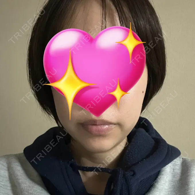 ヒアルロン酸注入（あご） Otus Clinic 【オータスクリニック】 AFTER メイン用