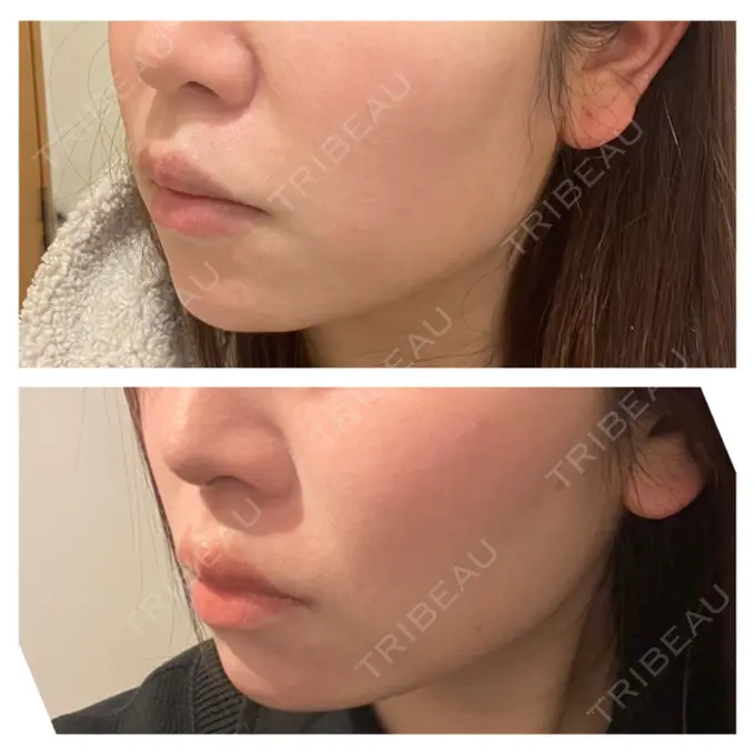 ハイフ（顔） 共立美容外科 福岡院 DAY 12 メイン用