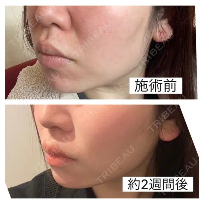 ハイフ（顔） 共立美容外科 福岡院 AFTER メイン用