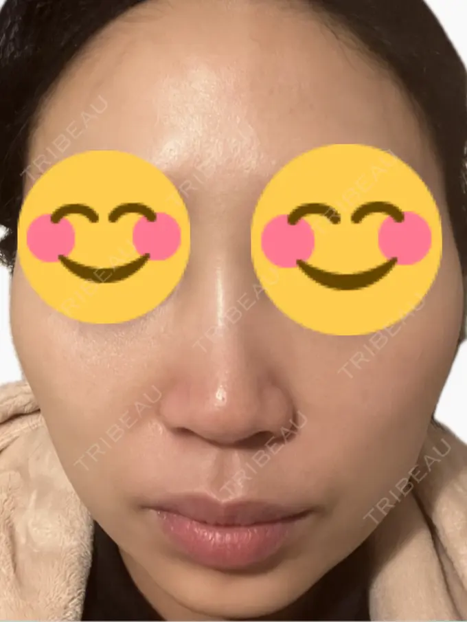 プラセンタ注射 美容皮膚科エルムクリニック 麻布院 DAY 6 メイン用