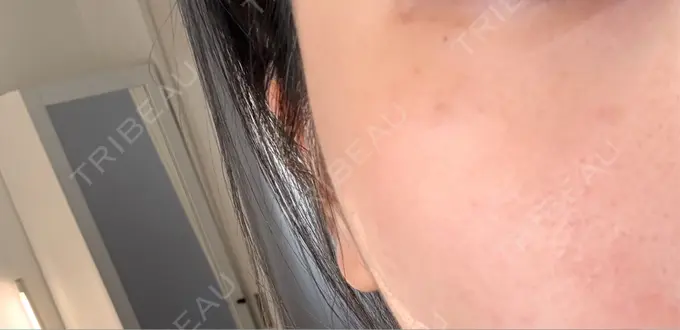 ルメッカ PureMe Skin Clinic（ピュアミースキンクリニック麻布） DAY 12 メイン用