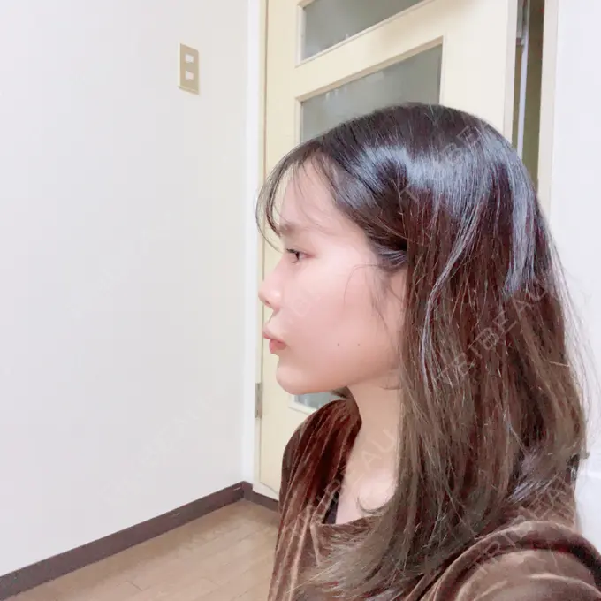 ボトックス（口角） / ヒアルロン酸注入（頬） おおたかの森ビューティークリニック DAY 8 メイン用