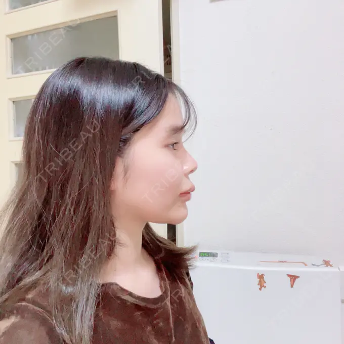 ボトックス（口角） / ヒアルロン酸注入（頬） おおたかの森ビューティークリニック DAY 8 メイン用