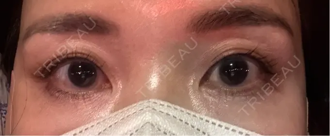 ヒアルロン酸注入（涙袋） / ヒアルロン酸注入（唇） APスキンクリニック銀座 AFTER メイン用