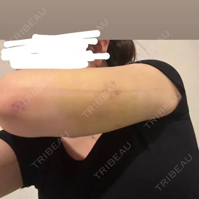 脂肪吸引（顔） / 脂肪吸引（二の腕） / ジョールファット除去 / 脂肪吸引（肩） 湘南美容クリニック Regno 銀座院 DAY 7 メイン用