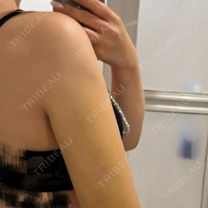 脂肪吸引（顔） / 脂肪吸引（二の腕） / ジョールファット除去 / 脂肪吸引（肩） 湘南美容クリニック Regno 銀座院 DAY 7 メイン用