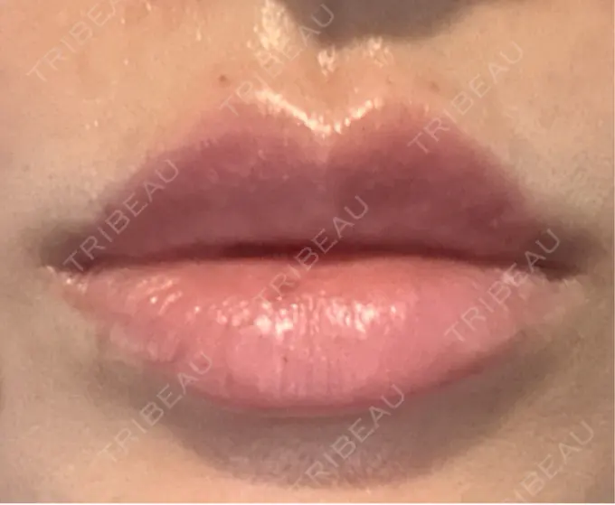 ヒアルロン酸注入（涙袋） / ヒアルロン酸注入（唇） APスキンクリニック銀座 DAY 1 メイン用