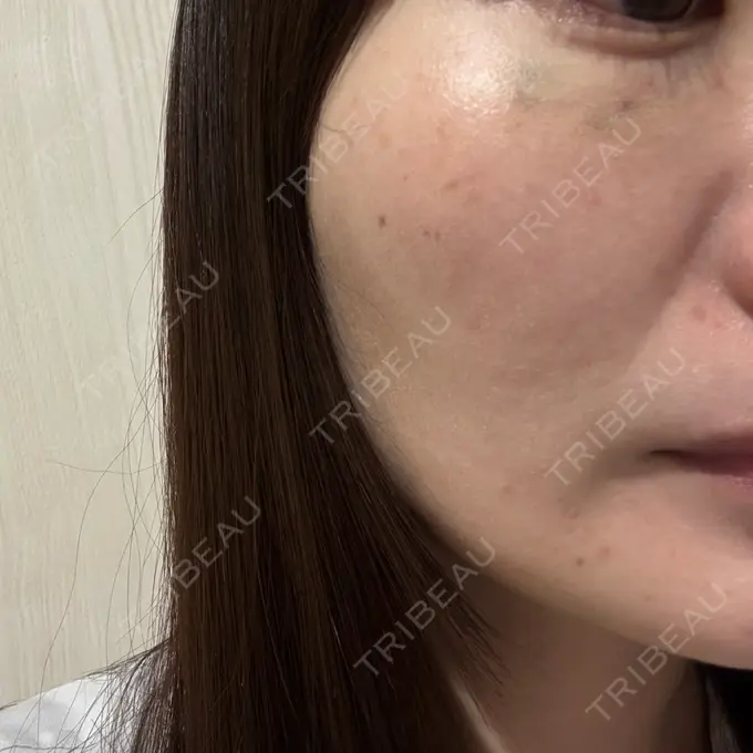 スネコス ルラ美容クリニック 仙台院 / ルラスキンクリニック 仙台院 DAY 17 メイン用