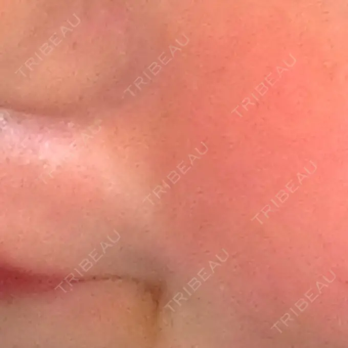 ボトックス（口角） / ヒアルロン酸注入（鼻翼基部） DMTC CLINIC 日本橋院 AFTER メイン用