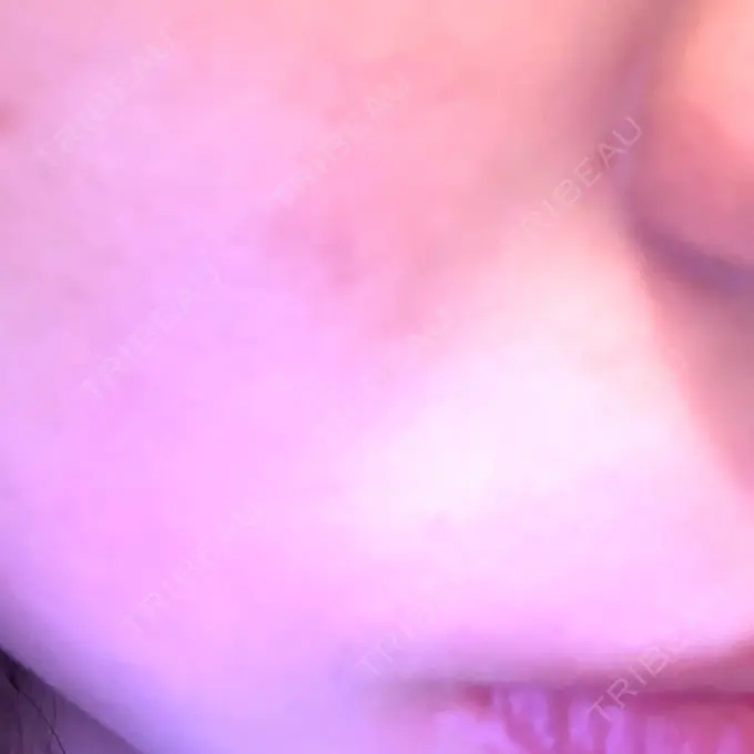 ボトックス（口角） / ヒアルロン酸注入（鼻翼基部） DMTC CLINIC 日本橋院 DAY 0 メイン用