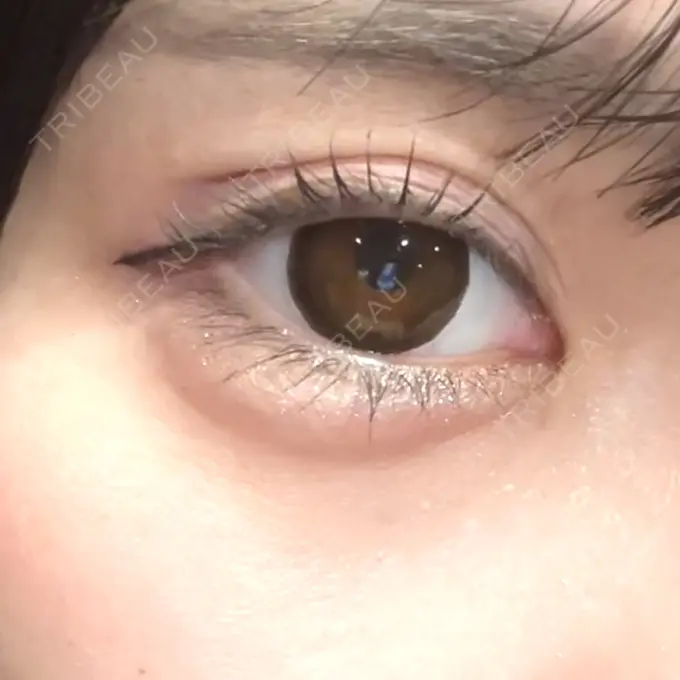 ヒアルロン酸注入（涙袋） アリエル美容クリニック 水戸院 DAY 2 メイン用