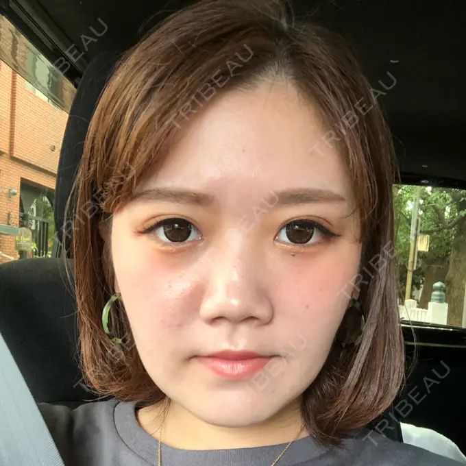 骨切り（あご） / 脂肪吸引（顔） 東京美容外科 赤坂院 DAY 72 メイン用