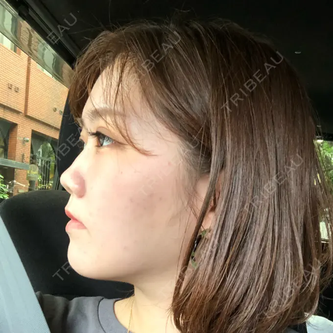 骨切り（あご） / 脂肪吸引（顔） 東京美容外科 赤坂院 DAY 72 メイン用