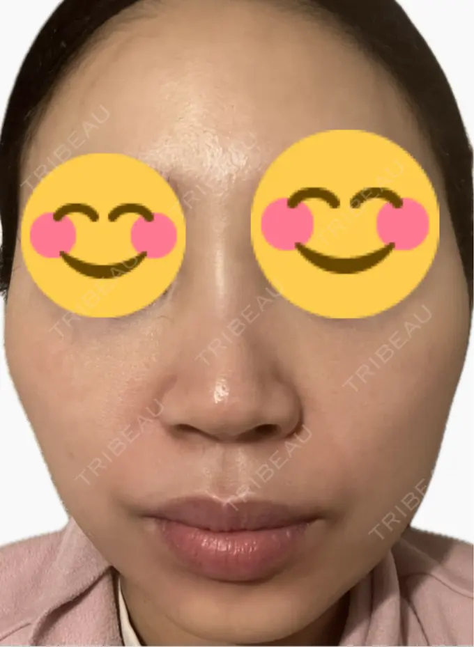 プラセンタ注射 美容皮膚科エルムクリニック 麻布院 DAY 7 メイン用