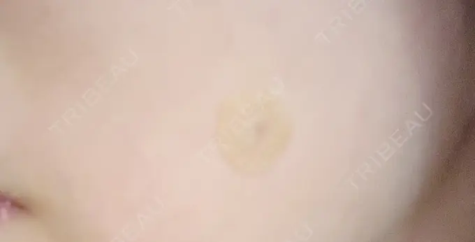 ほくろ・いぼ切除（肌） 札幌中央クリニック DAY 6 メイン用