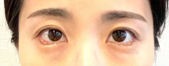 目尻切開 / タレ目形成・グラマラスライン（埋没） LOUIS CLINIC 二子玉川院【ルイクリニック】 DAY 3 メイン用