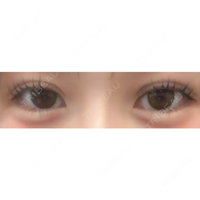 二重埋没 アリエル美容クリニック 水戸院 DAY 24 メイン用