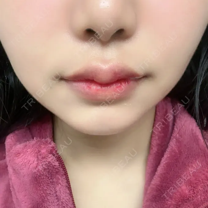 ヒアルロン酸注入（鼻翼基部） 共立美容外科 福岡院 AFTER メイン用