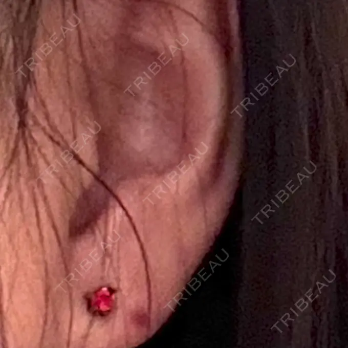 ピアス穴あけ 新宿ラクル美容外科クリニック 六本木院 AFTER メイン用
