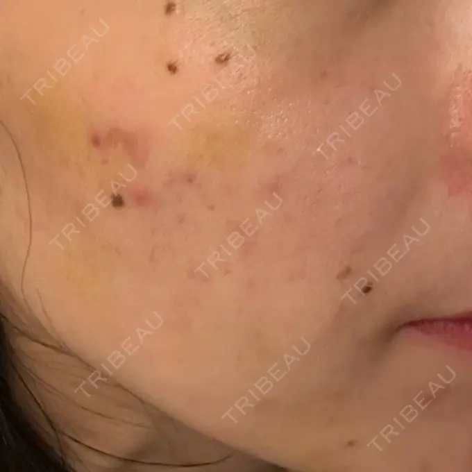 肌育注射（ジュベルックなど） DMTC CLINIC 日本橋院 AFTER メイン用