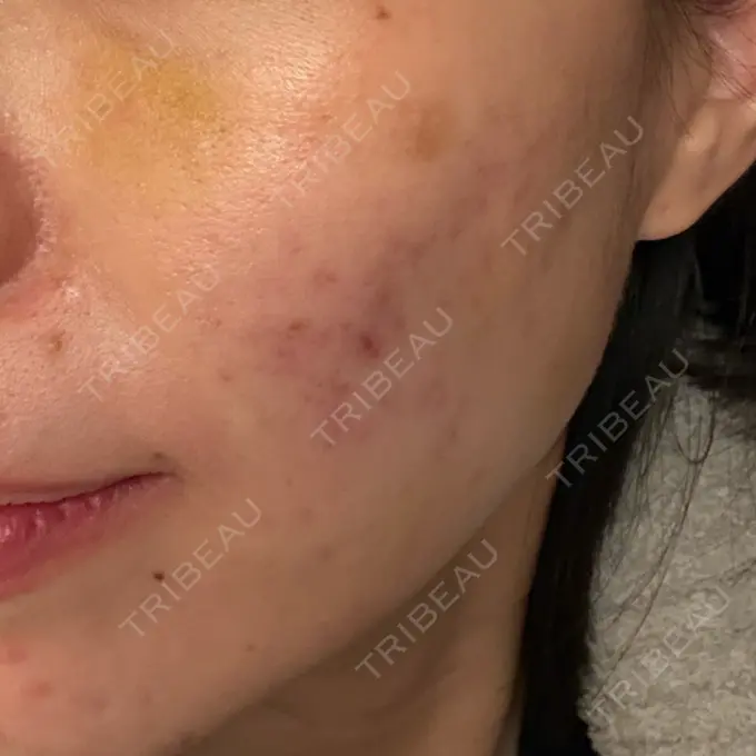 肌育注射（ジュベルックなど） DMTC CLINIC 日本橋院 DAY 11 メイン用