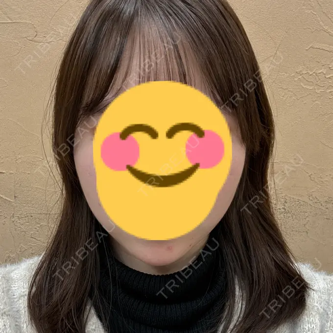 糸リフト / 脂肪吸引注射（顔） APスキンクリニック銀座 DAY 23 メイン用