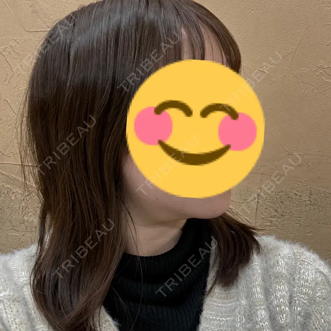 糸リフト / 脂肪吸引注射（顔） APスキンクリニック銀座 DAY 23 メイン用