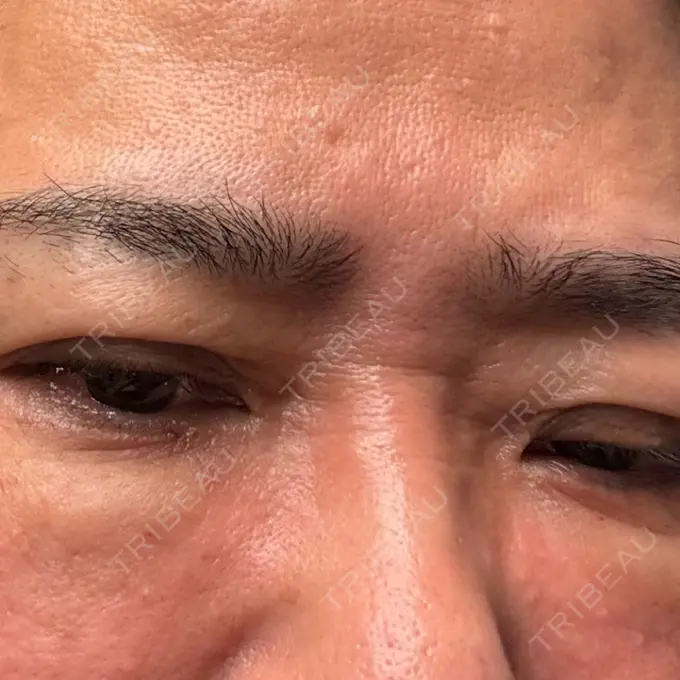 水光注射（ハリ・美肌） Natural Skin Clinic 笹塚院 DAY 0 メイン用