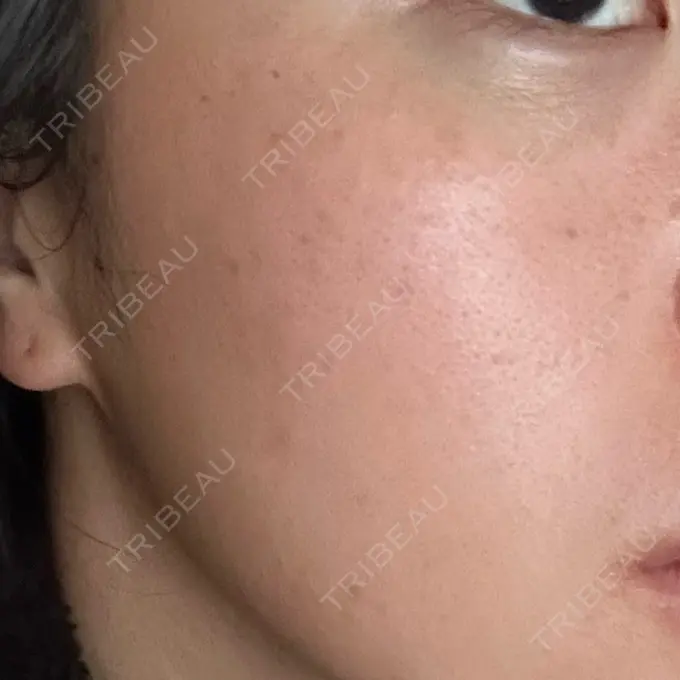 水光注射（ハリ・美肌） 城本クリニック 姫路院 DAY 1 メイン用