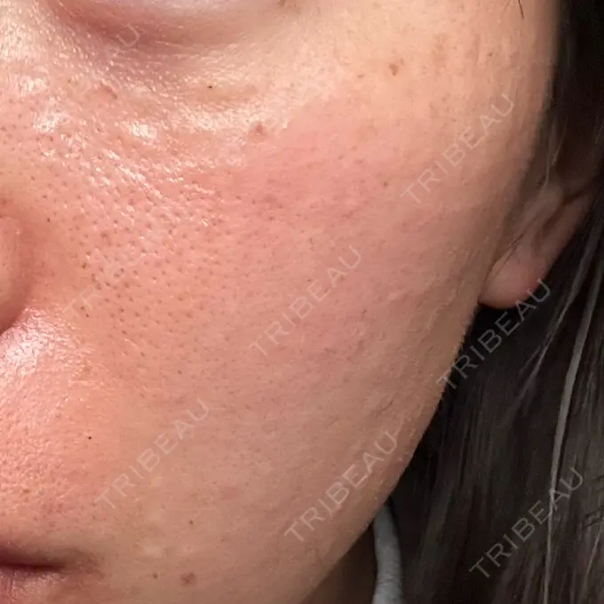 水光注射（ハリ・美肌） 城本クリニック 姫路院 DAY 1 メイン用