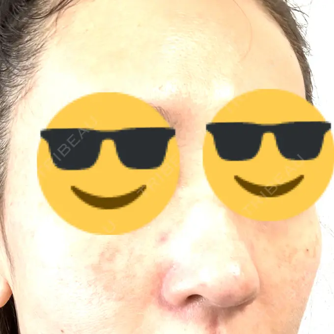 毛穴洗浄（ハイドラフェイシャルなど） / ピコレーザートーニング（美白・肝斑） 日本美容・医療クリニック 六本木院 DAY 1 メイン用