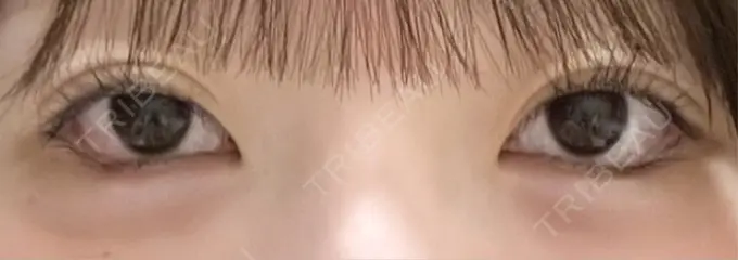 目尻切開 / タレ目形成・グラマラスライン（埋没） / ボトックス（タレ目） LOUIS CLINIC 二子玉川院【ルイクリニック】 DAY 1 メイン用