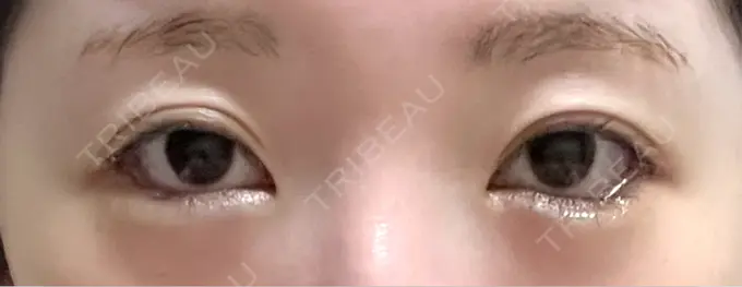 目尻切開 / タレ目形成・グラマラスライン（埋没） / ボトックス（タレ目） LOUIS CLINIC 二子玉川院【ルイクリニック】 DAY 2 メイン用