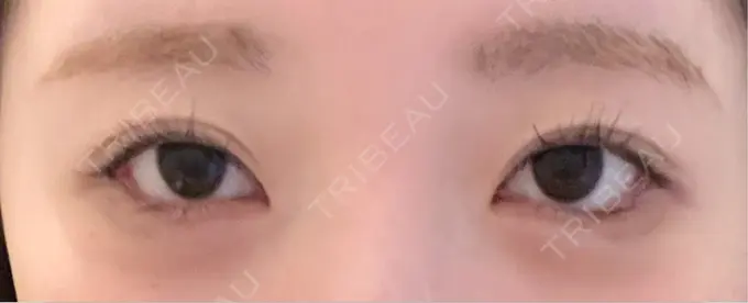 目尻切開 / タレ目形成・グラマラスライン（埋没） / ボトックス（タレ目） LOUIS CLINIC 二子玉川院【ルイクリニック】 AFTER メイン用