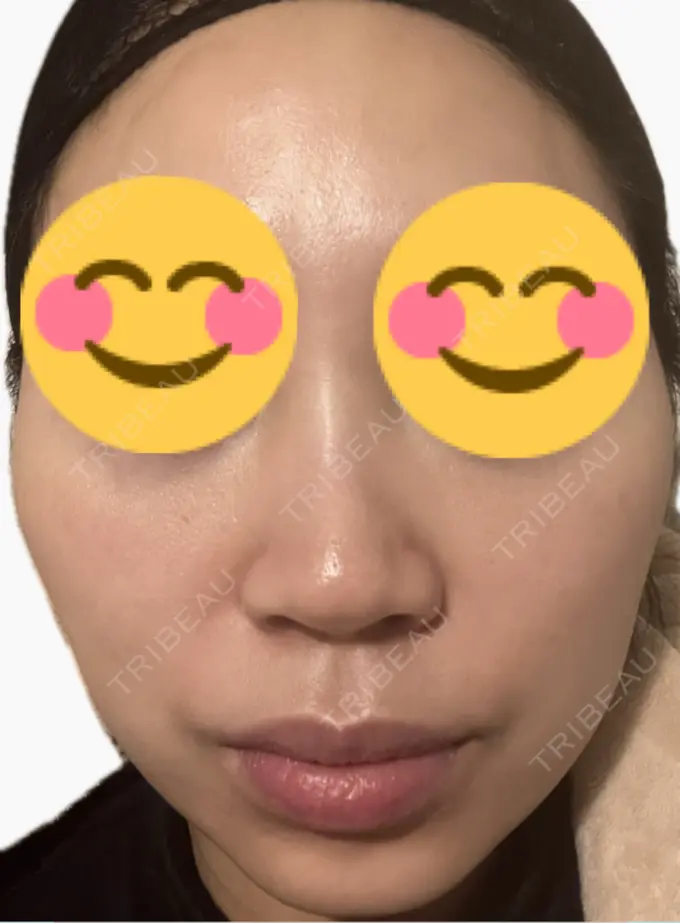 プラセンタ注射 美容皮膚科エルムクリニック 麻布院 DAY 8 メイン用