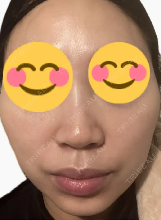 医療脱毛（顔） タイムルクリニック DAY 2 メイン用