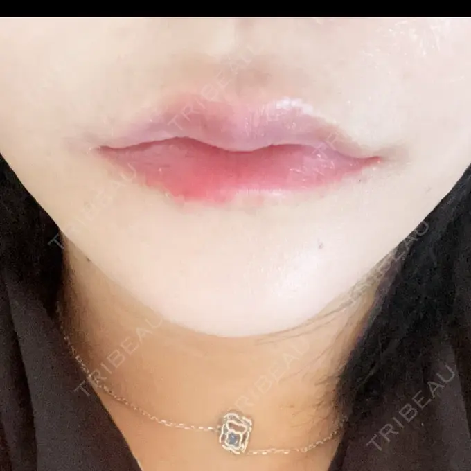 ヒアルロン酸注入（涙袋） アリエル美容クリニック 水戸院 DAY 3 メイン用