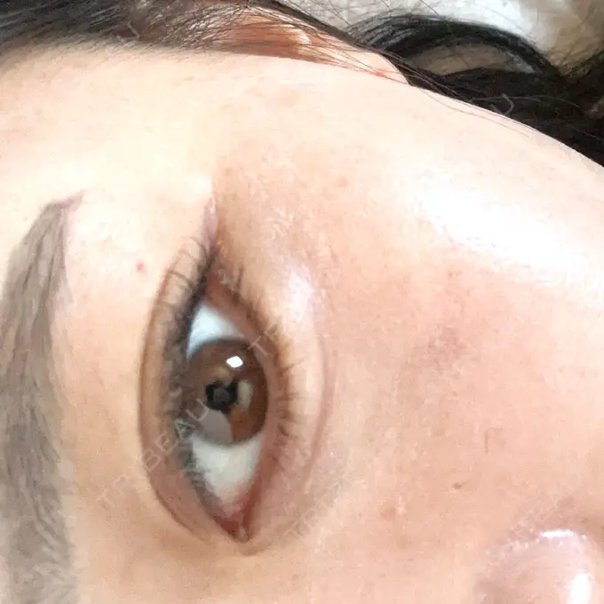 ヒアルロン酸注入（涙袋） アリエル美容クリニック 水戸院 DAY 3 メイン用